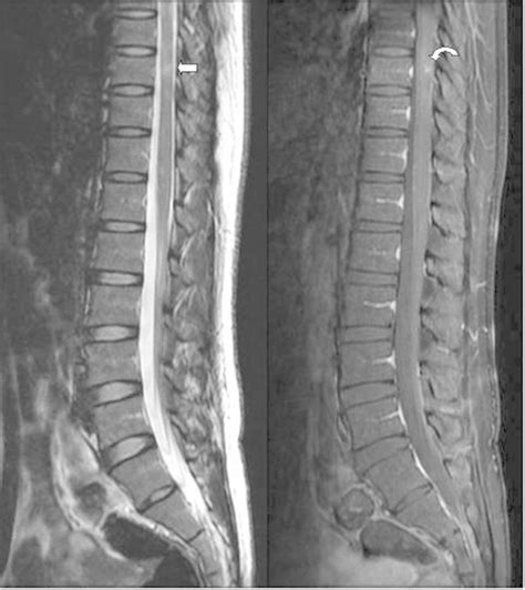 Low Thoracic And Lumbar Spine Mri Showing A Hyperintense Lesion In The