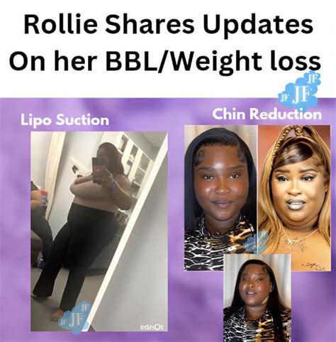 Rollie Surgery Update Rbaddiessouth