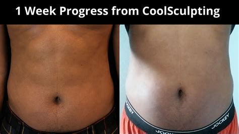 1 Week Progress From Coolsculpting Fat Loss Coolsculpting Youtube