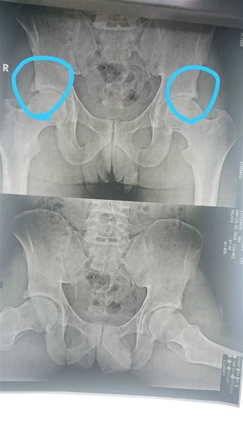 Os Acetabuli Radiology Bones Bone Joint