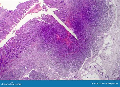 Suppurative Appendicitis Light Micrograph Stock Photography