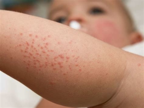 Common Skin Conditions In Infants And Babies