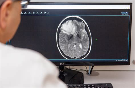 Ai May Help Brain Cancer Patients Avoid Biopsy