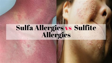 What Is A Real Sulfa Drug Allergic Reaction