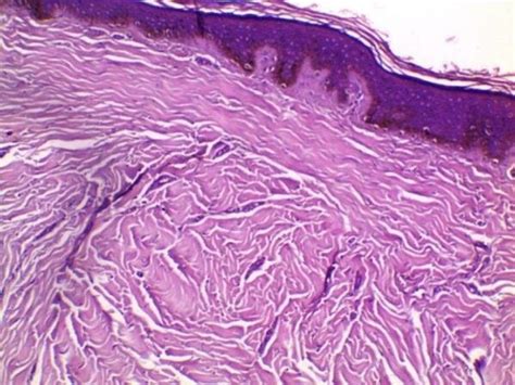 The Histopathology Of Hypertrophic Scar Tissue Before Treatment Is