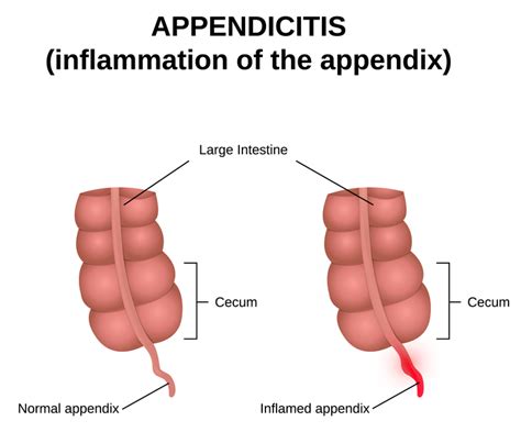 Burst Appendix Symptoms