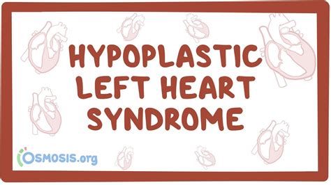 Hypoplastic Left Heart Syndrome Video And Anatomy Osmosis