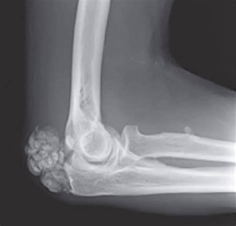 Lateral Radiographs Of The Right Elbow With Tumoral Calcinosis Of The
