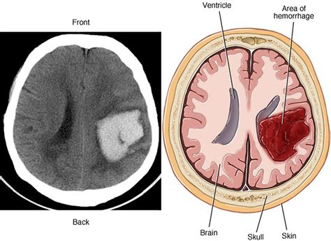 Arteriovenous Malformation Brain Avm Causes Symptoms Treatment