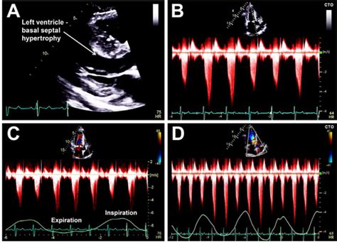 Marked Respiratory Related Variation In Lvot Gradients In Hypertrophic
