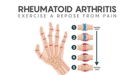 Can You Exercise With Rheumatoid Arthritis Exercise Poster