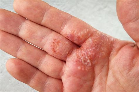 Tratamiento De La Dermatitis De Contacto Muy Salud