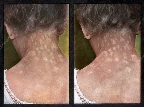 Rash Caused By Syphilis Stock Image C0222280 Science Photo Library