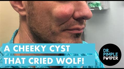The Cheek Cyst That Cried Wolf Youtube