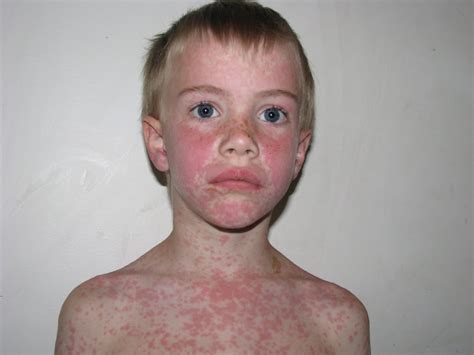 The Foster Home Allergic Reaction