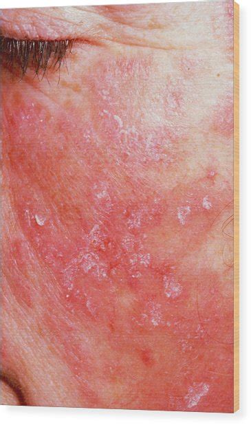 Rash Of Systemic Lupus Erythematosus On Cheek Photograph By Science