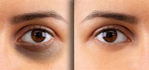 Dark Eye Circles Treatment Smooth And Simple Aesthetic Treatments Vlr