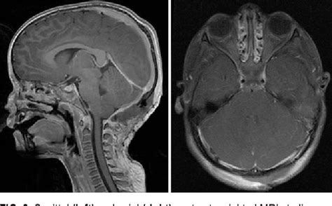 Figure 3 From Occipital Aneurysmal Bone Cyst Rupture Following Head