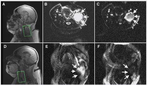 Figure 1 From Diffusion Weighted Magnetic Resonance Imaging In Neck