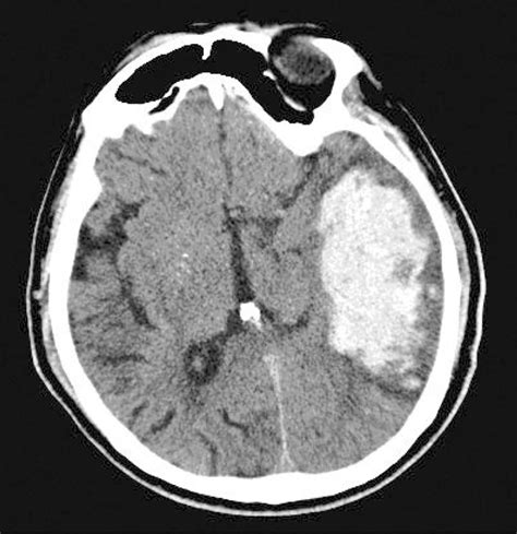 Preoperative Computed Tomography Scans Showing Left Frontoparietal