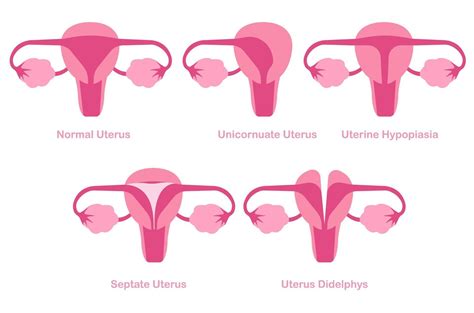 Congenital Mullerian Anomalies Or Uterine Abnormalities Concept