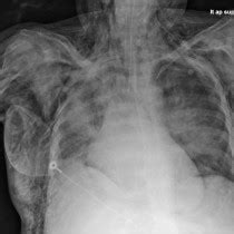 Pneumothorax And Surgical Emphysema Radiology At St Vincent S