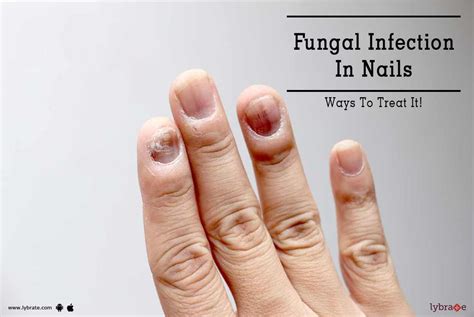 Fungal Infection In Nails Ways To Treat It By Dr Prashant Sinha