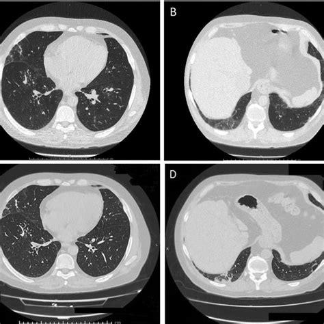 Chest Ct Scan Images At The Time Of Hospital Admission A And B And