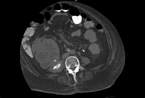 Psoas Major Ct Scan