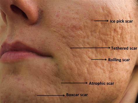 Acne Scar Treatment Cincinnati Acne Scar Lasers Fillers For Acne Scars