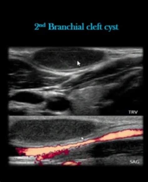 Branchial Cleft Cyst Ultrasound