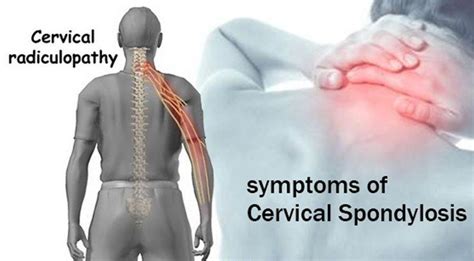 Chiropractic Care To Treat Pinched Nerves Cervical Spondylosis
