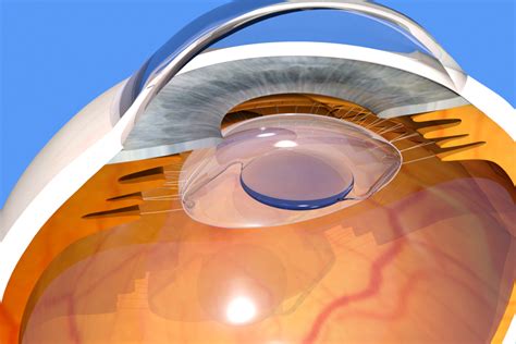 Find the best urgent care locations in newark, de and book online today. Safe Cataract Treatments Newark, DE | Eye Care of Delaware ...