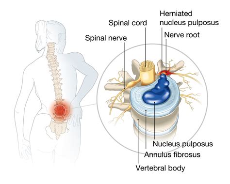 Home Treatments To Reduce Pain From A Bulging Disc Midsouth Pain