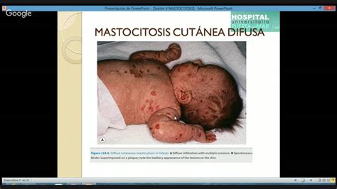 Mastocitosis Youtube