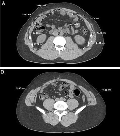 Lateral Abdominal Wall Measurements On Axial Ct Images A Axial Ct