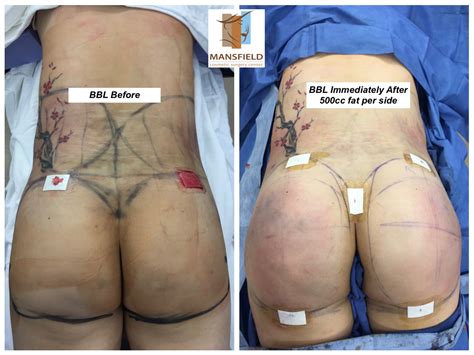 Your own body fat is used to augment the buttocks in the most natural of ways. Brazilian Butt Lift - 360 Lipo | Mansfield Arlington ...