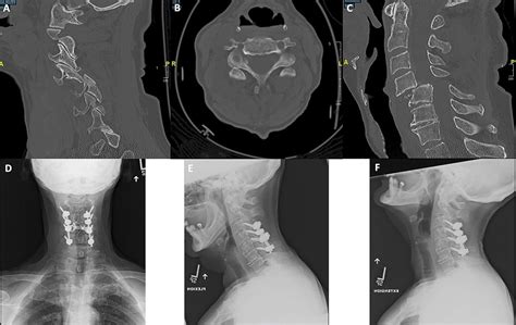 Traumatic Cervical Facet Fractures And Dislocations Jbjs Reviews