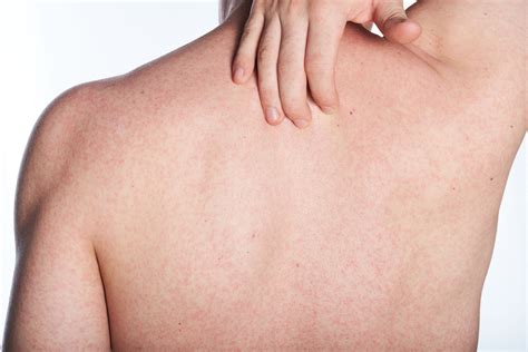 Autumn Allergies And Skin Problems Advanced Dermatology P C