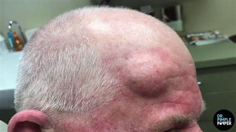 Dr Pimple Popper Cyst So Deep It Takes Three Squeezes To Get It All Out
