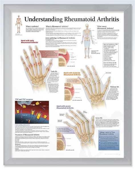 Rheumatoid Arthritis Exam Room Human Anatomy Poster Clinicalposters