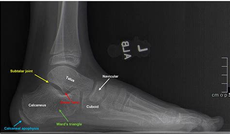 Cureus A Review Of Pediatric Heel Pain