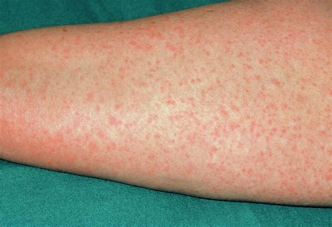 Penicillin Allergy On The Forearm Photograph By Dr P Marazzi Science