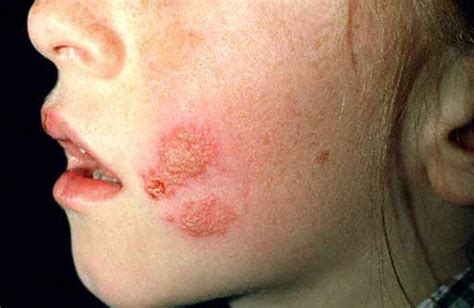 Oral Herpes Cold Sore Vs Apthous Ulcer Canker Sore Aquabird