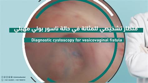 منظار تشخيصي للمثانة في حالة ناسور بولي مهبلي Diagnostic Cystoscopy For Vesicovaginal Fistula