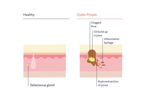 How To Treat Cystic Acne Curology