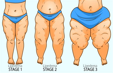 Learn About Stages And Types Of Lipedema