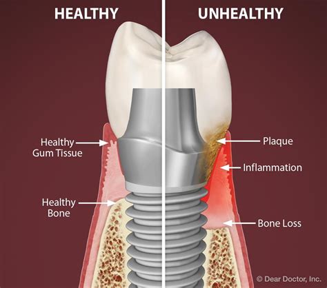 Peri Implantitis Gum Disease Can Cause Implant Failure