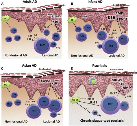 The Immunology Of Atopic Dermatitis And Its Reversibility With Broad