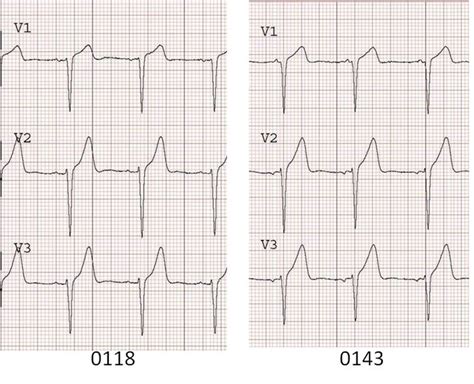 Dr Smiths Ecg Blog Acute Anterior Stemi From Lad Occlusion Or